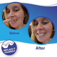 Smile Veneer (Upper & Lower Included)
